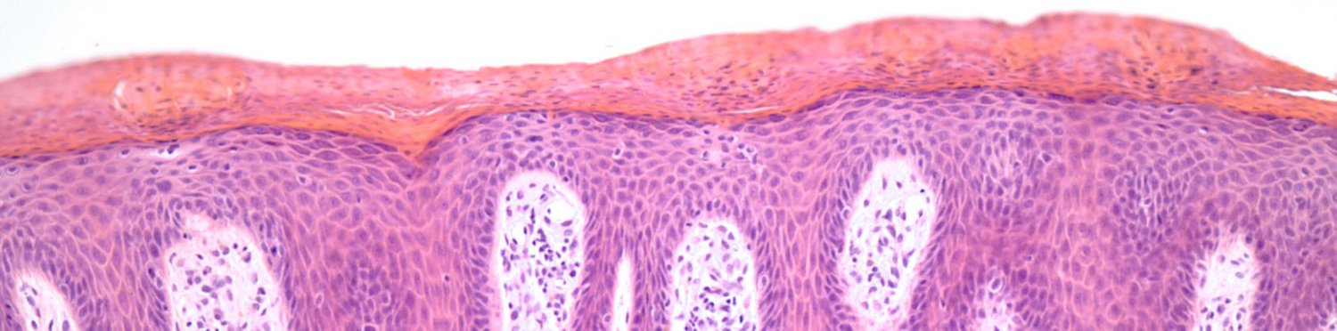 Histologie Psoriasis